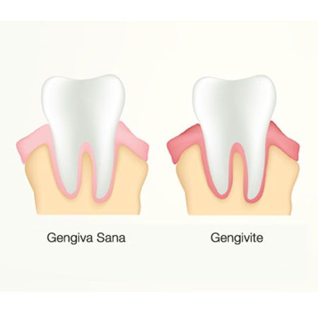 GENGIVITE