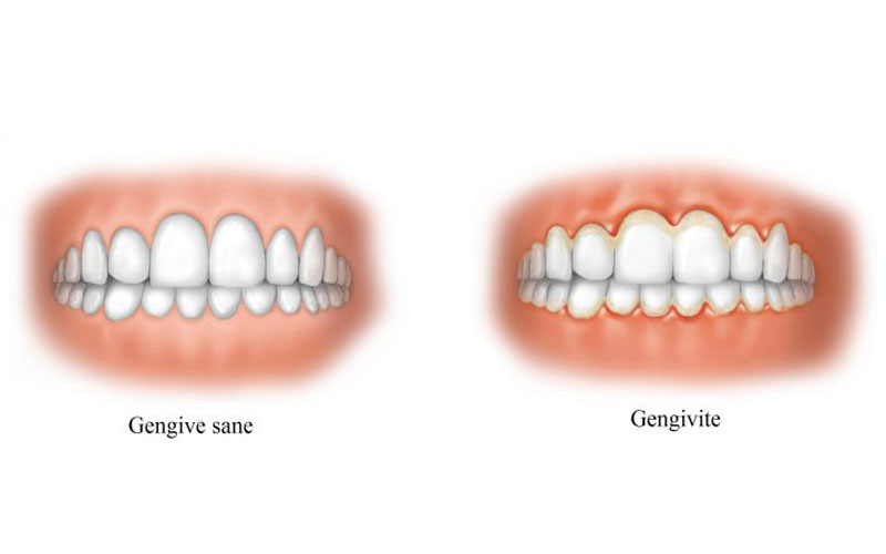 GENGIVITE