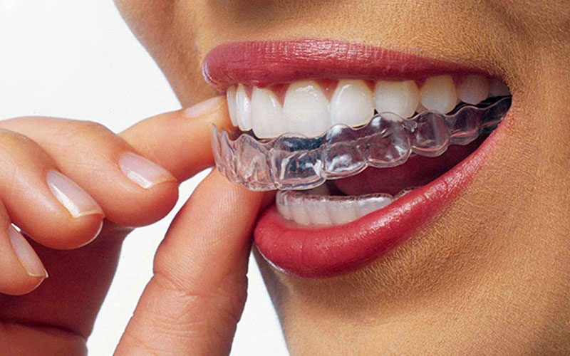 Invisalign